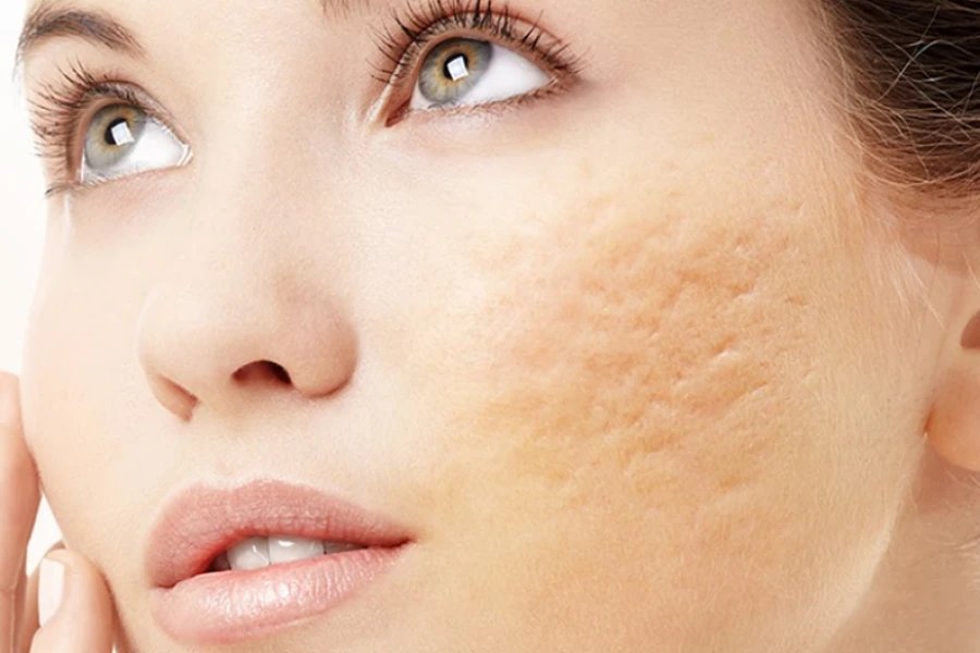 Cicatriz de Acne