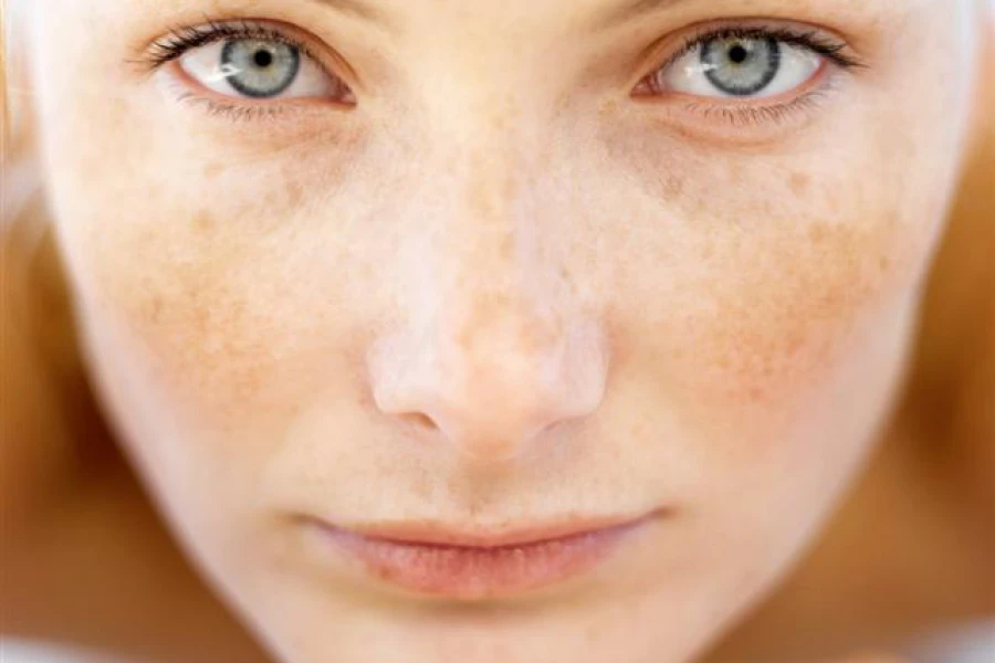 Melasma